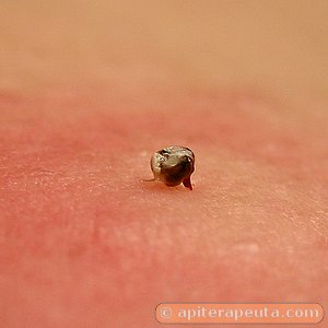 respuesta del organismo a la picadura de abeja HD